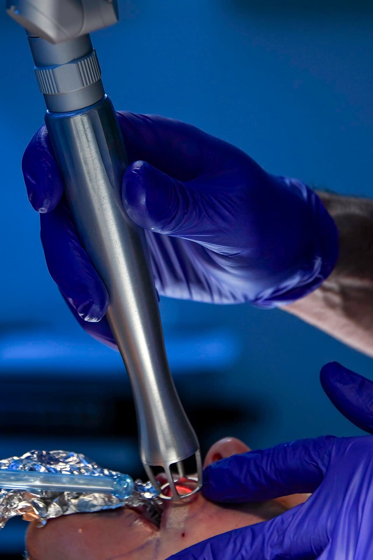 Gloved hand guiding a CO2 laser handpiece over facial skin during resurfacing