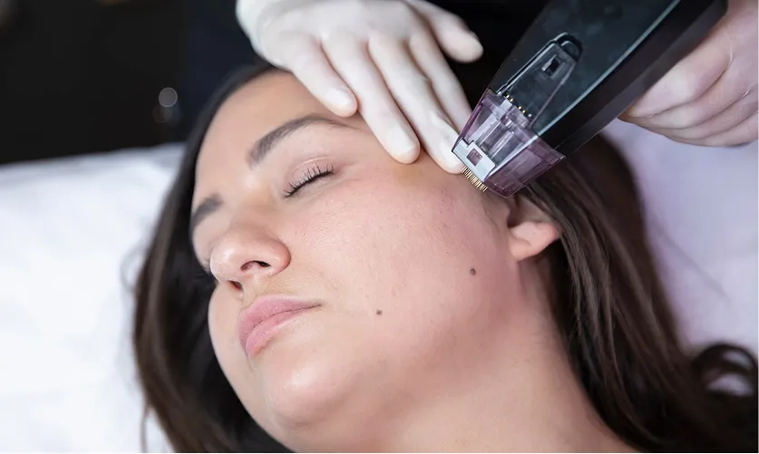An RF microneedling handpiece held against the cheek of a reclining patient