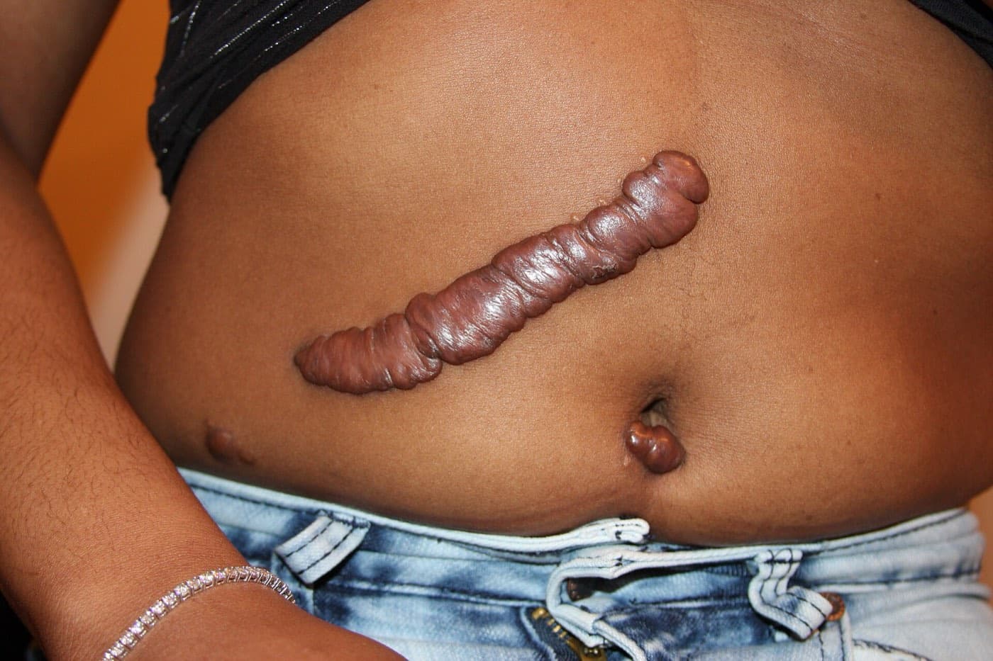 Raised, firm keloid scar along a surgical incision on the abdomen