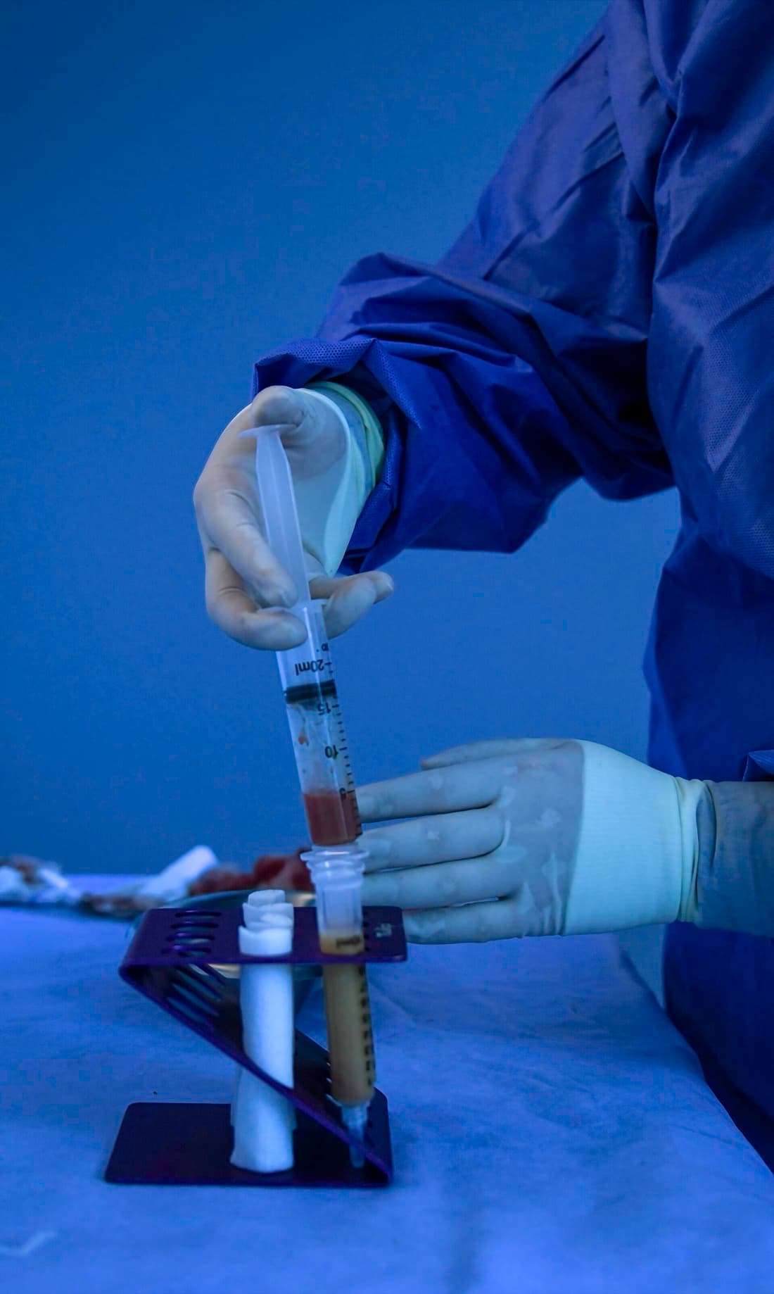 Gloved hands loading purified harvested fat into syringes in an operating room